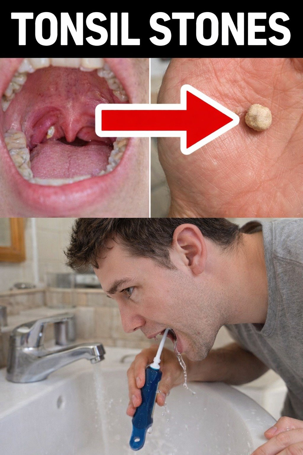 What Are Tonsil Stones? A Complete Guide to Understanding and Managing Them at Home